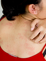 Ixekizumab FDA-Approved for Patients with Plaque Psoriasis