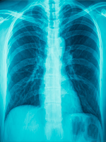 Alectinib New Standard of Care  for ALK-Positive Non–Small-Cell Lung Cancer